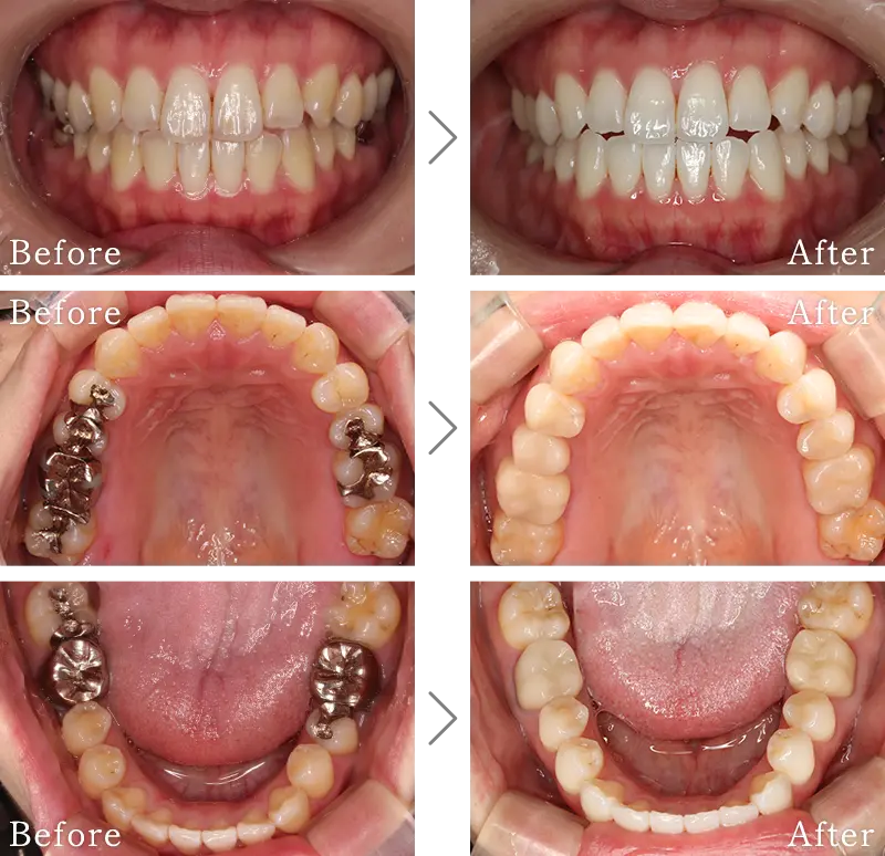 セラミック治療症例1