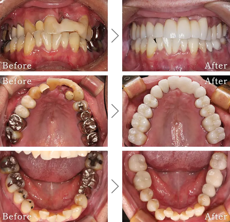 セラミック治療症例3