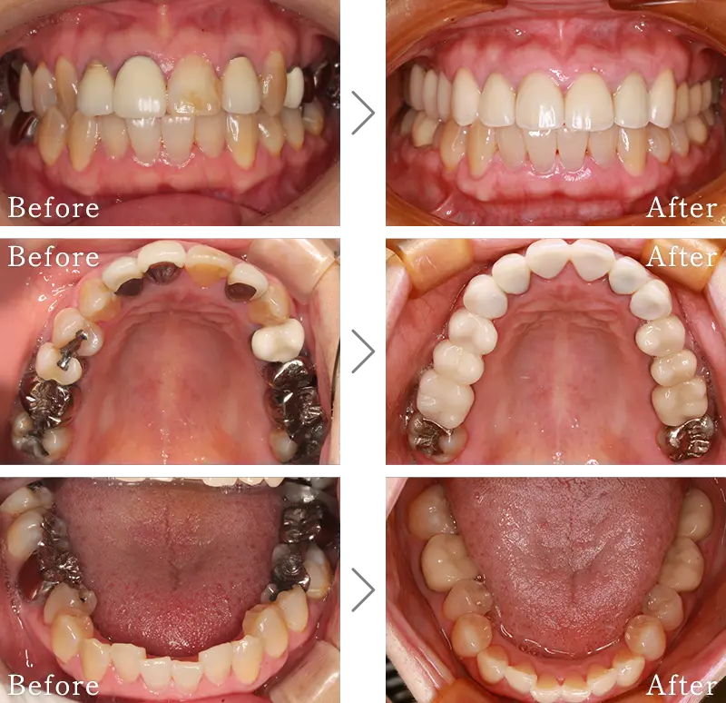 セラミック治療症例2