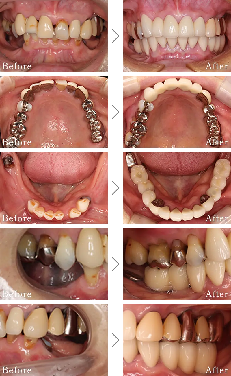 セラミック治療症例4