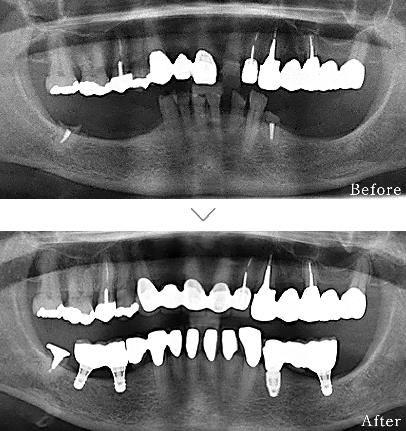 セラミック治療症例4