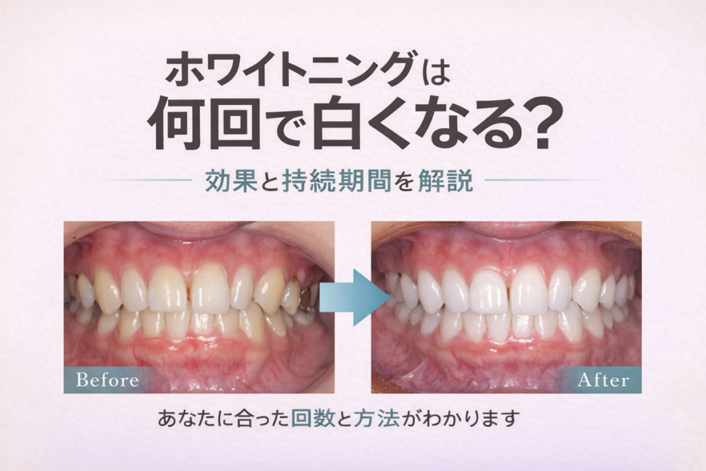 ホワイトニングは何回で白くなる？効果・持続期間・歯科と自宅の違いを徹底解説