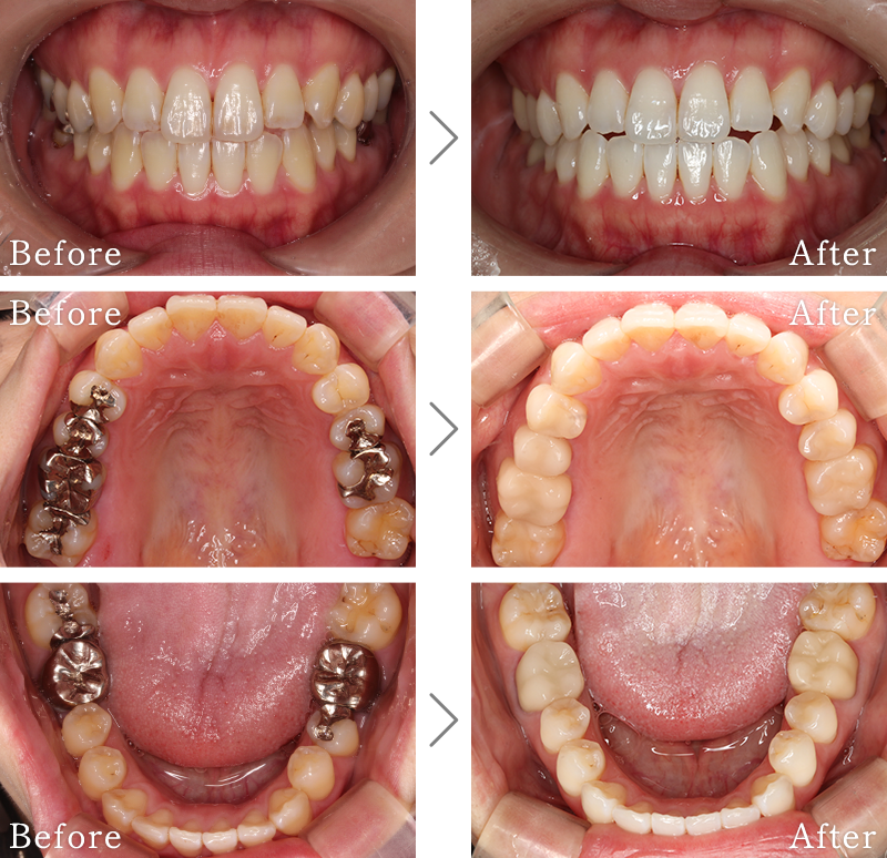 セラミック治療症例1