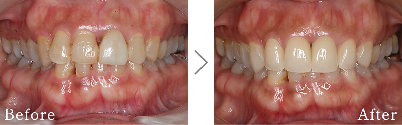 セラミック治療症例10