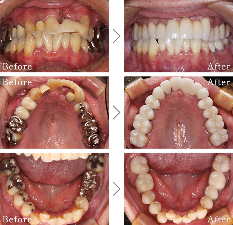 セラミック治療症例11