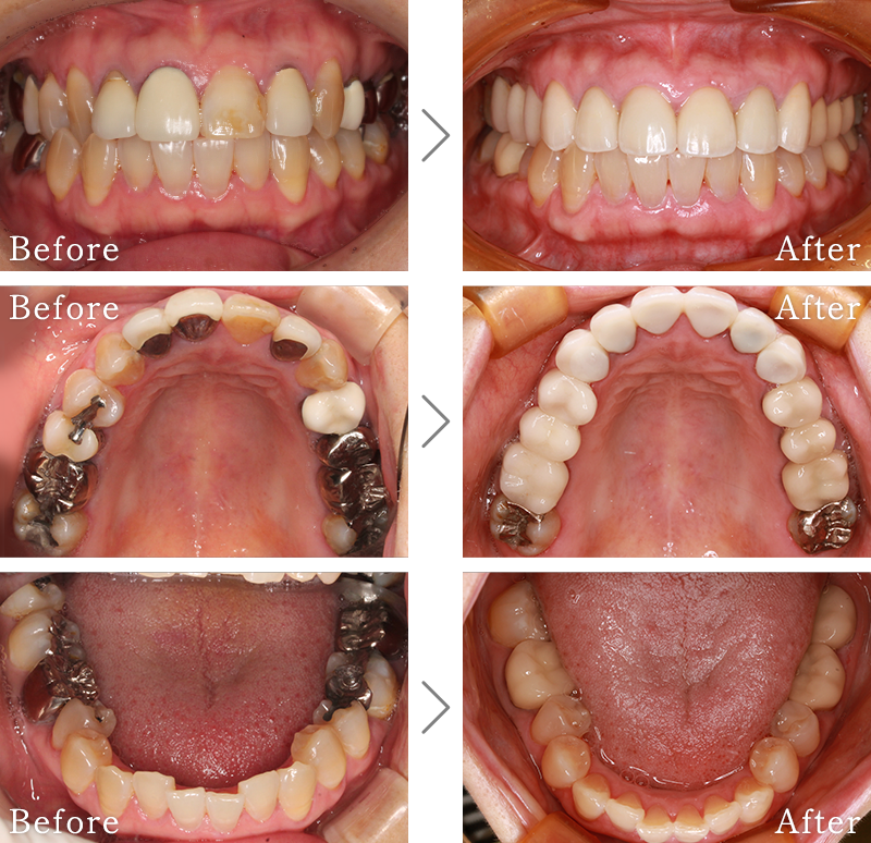セラミック治療症例2