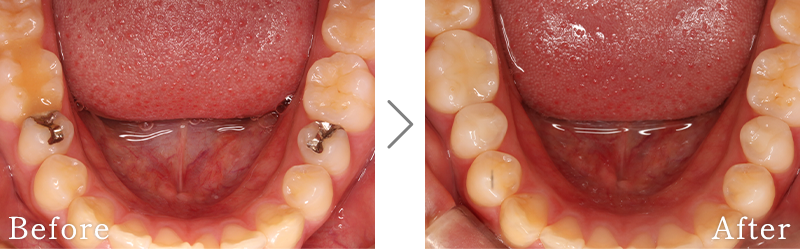 セラミック治療症例3