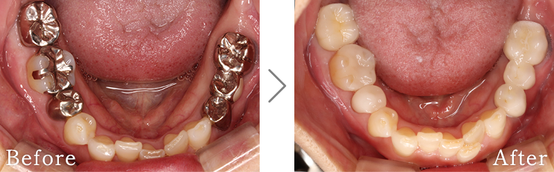 セラミック治療症例4