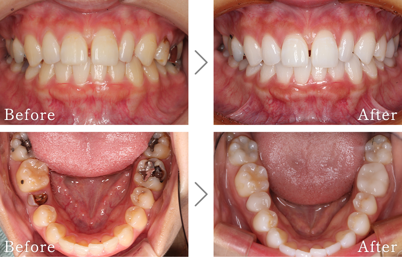 セラミック治療症例5