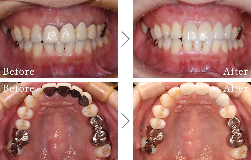 セラミック治療症例6