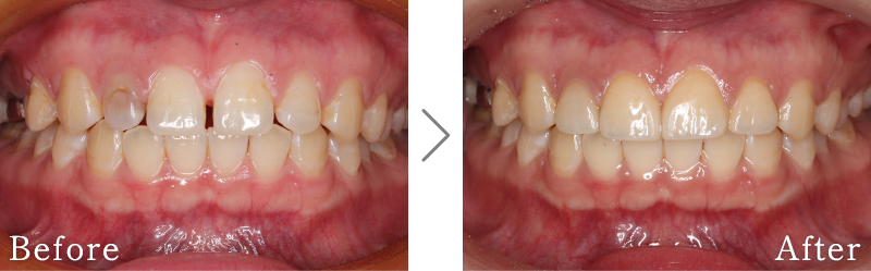セラミック治療症例7