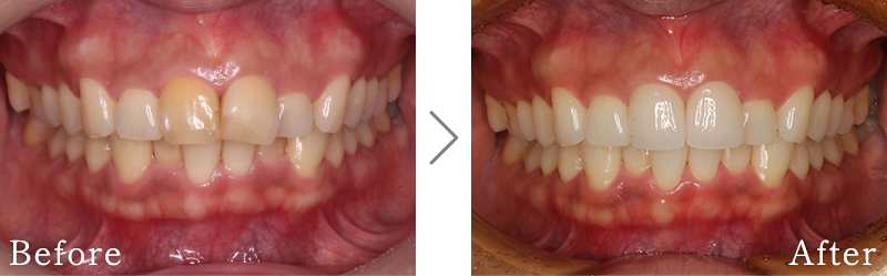 セラミック治療症例8