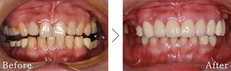 セラミック治療症例9