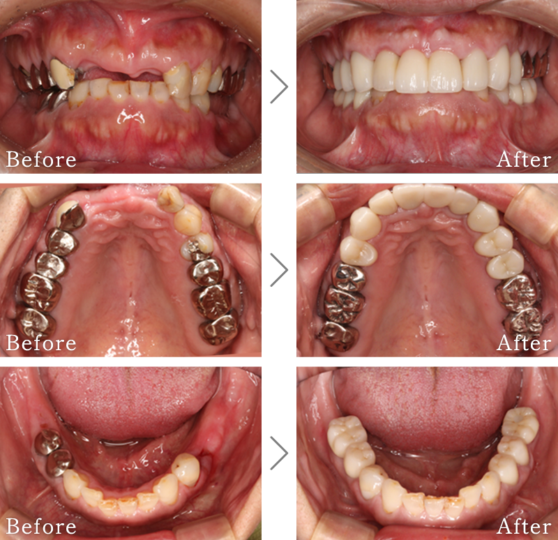 インプラント症例2