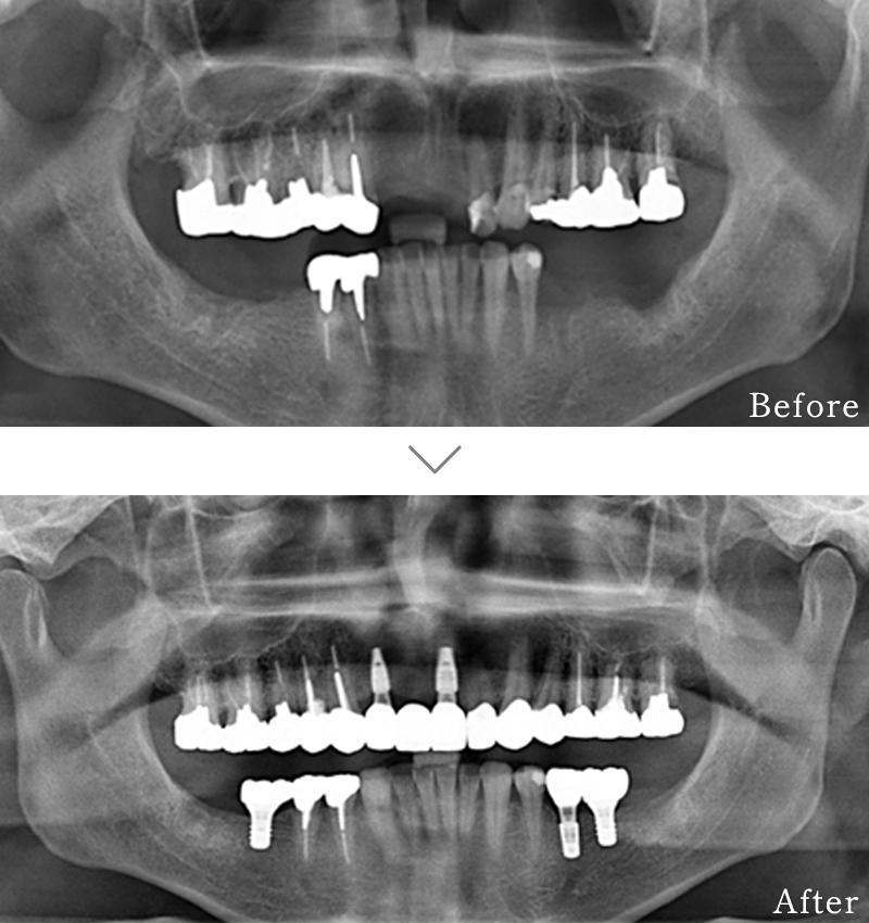 インプラント症例2