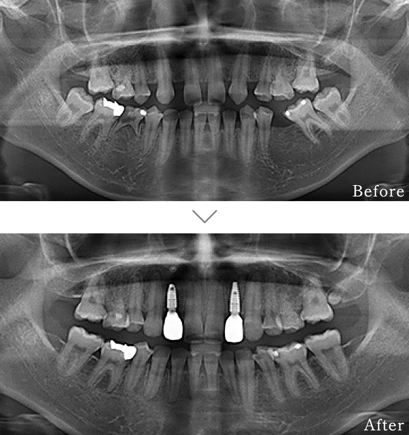 インプラント症例3