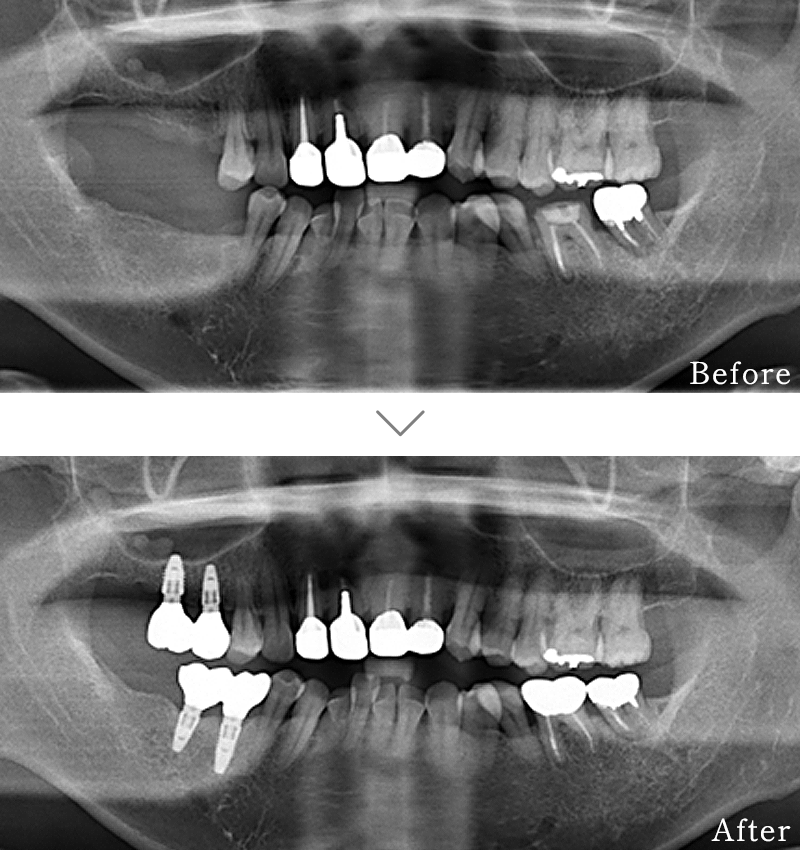 インプラント症例4