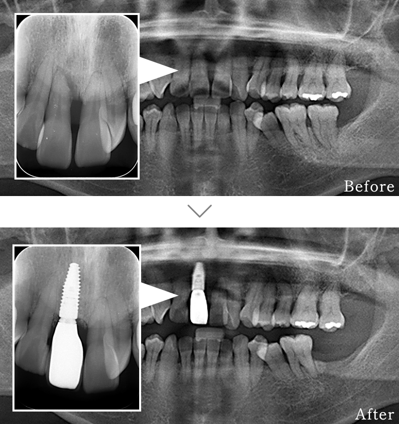 インプラント症例5