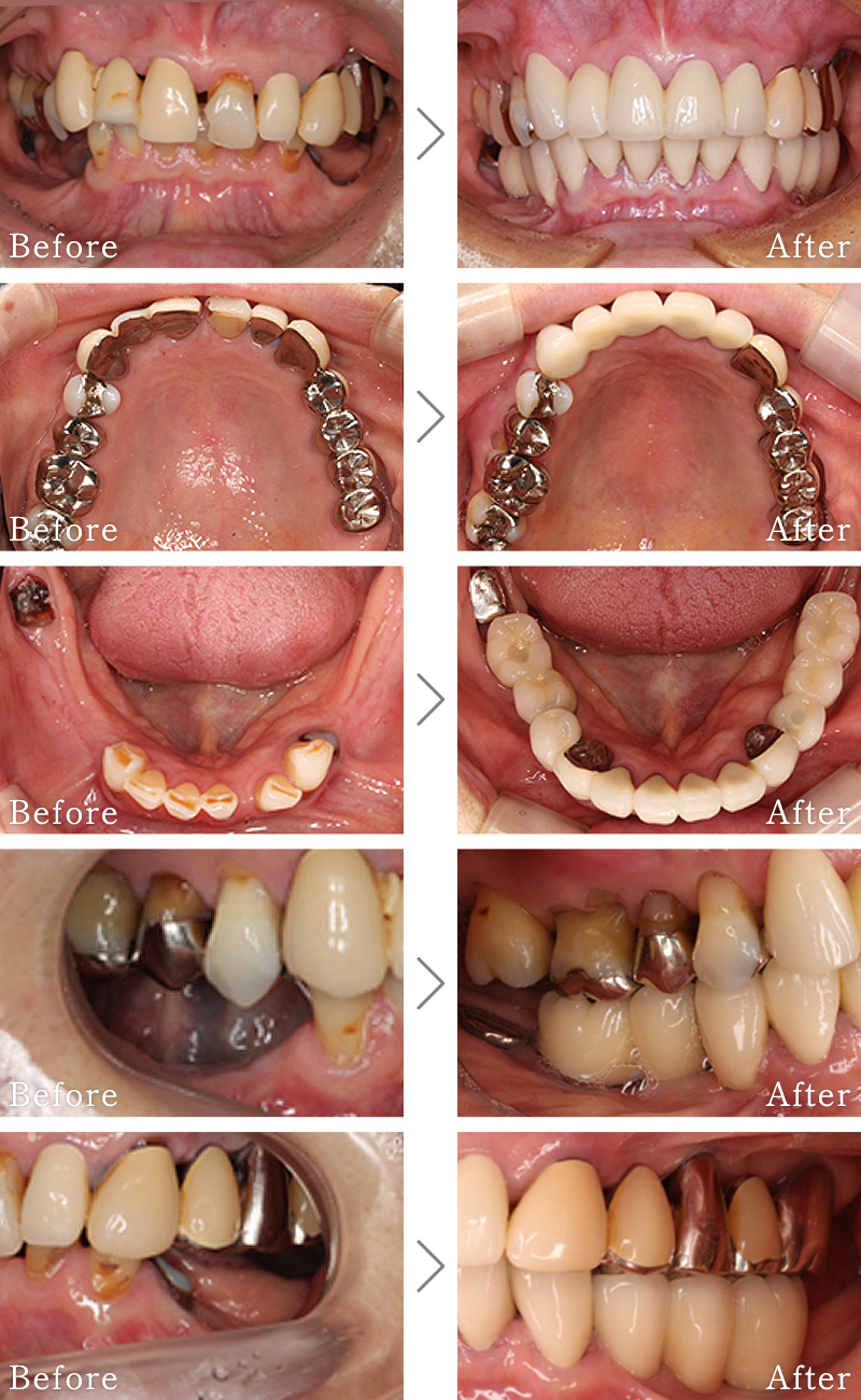インプラント症例6