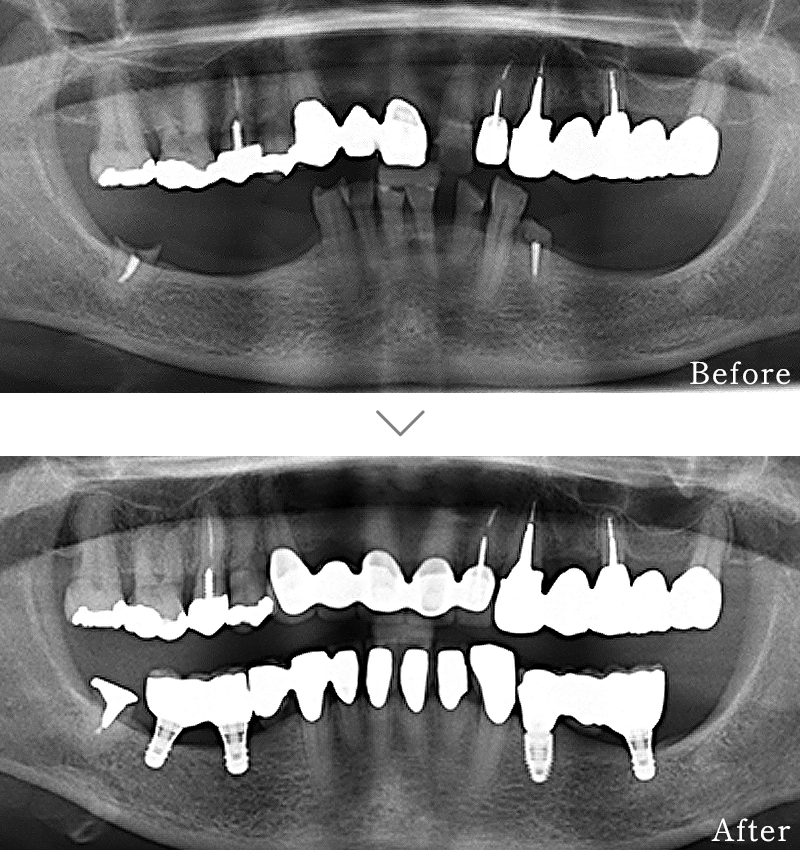 インプラント症例6
