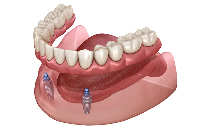 インプラントオーバーデンチャー
