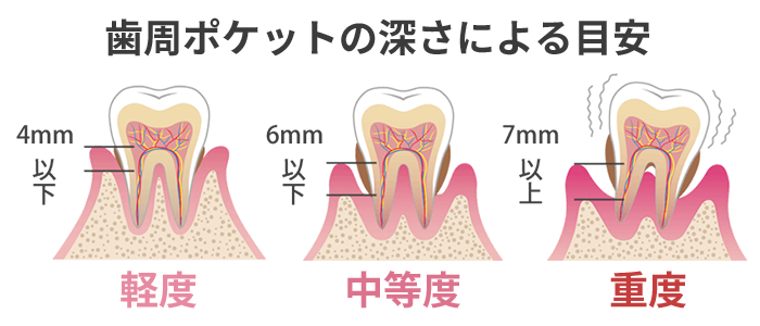 歯周ポケット