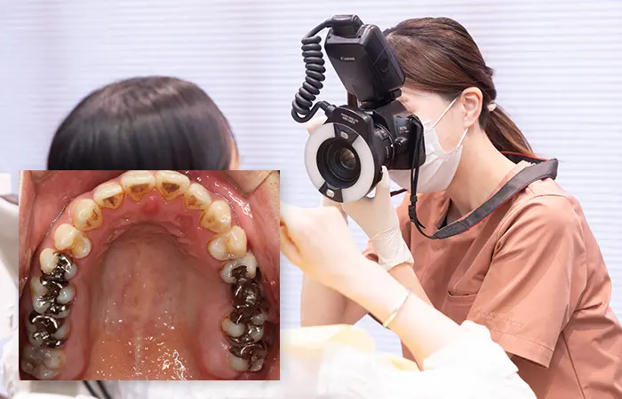 口腔内の写真撮影による予防歯科の検査