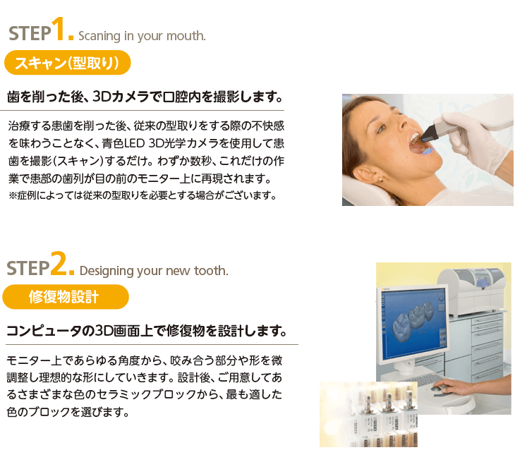 セレック治療:ステップ1・2