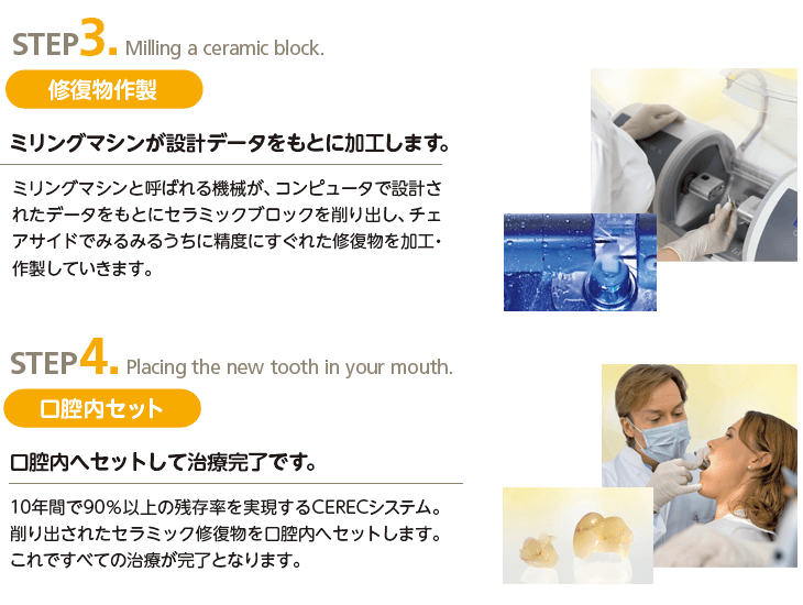 セレック治療:ステップ3・4