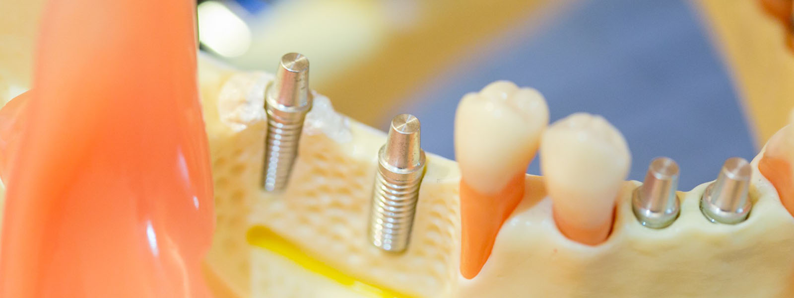 インプラント症例集