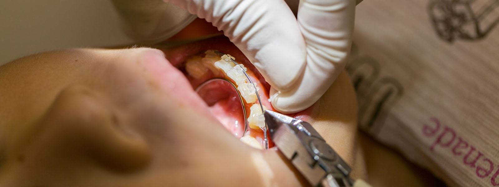 小児矯正症例集