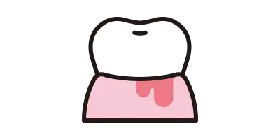 歯周病治療