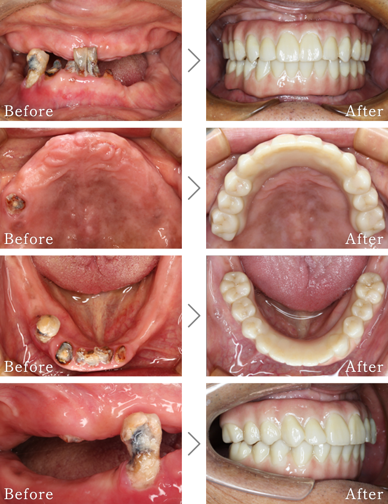 インプラント症例1