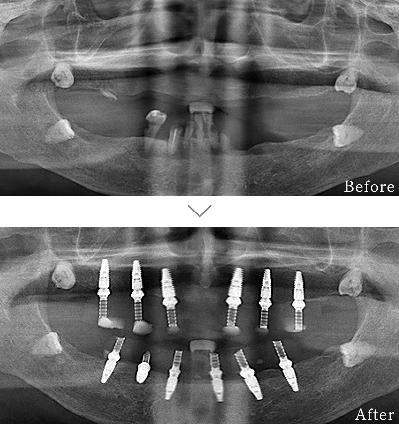 インプラント症例1