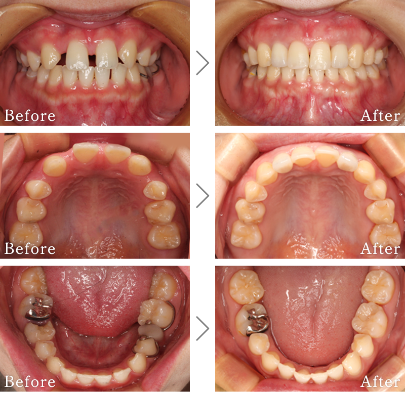 インプラント症例3