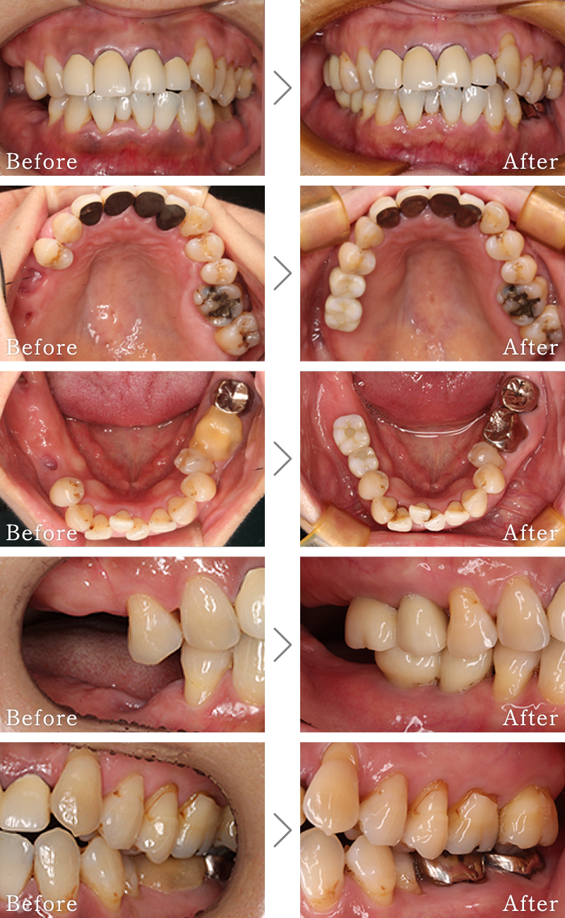 インプラント症例4