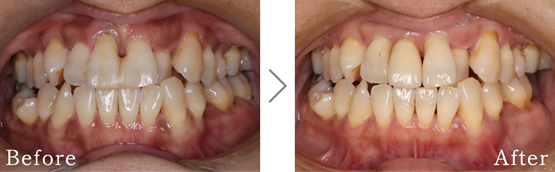 インプラント症例5