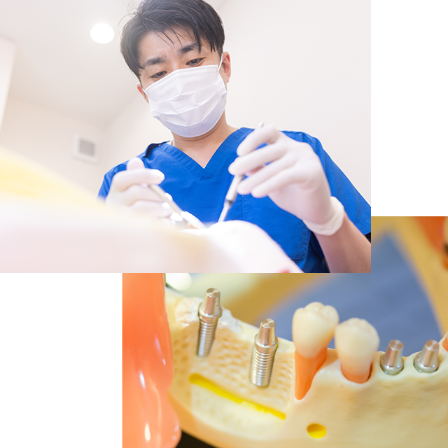 インプラント治療